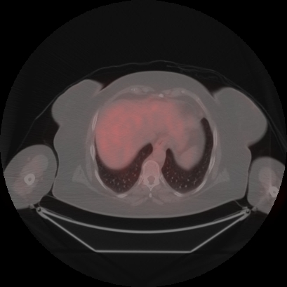 Brain metastasis (Radiopaedia 89847-106962 Axial lung window 50).jpg