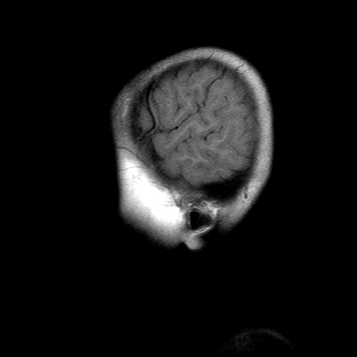 File:Brainstem ganglioglioma (Radiopaedia 10763-11224 Sagittal T1 2).jpg