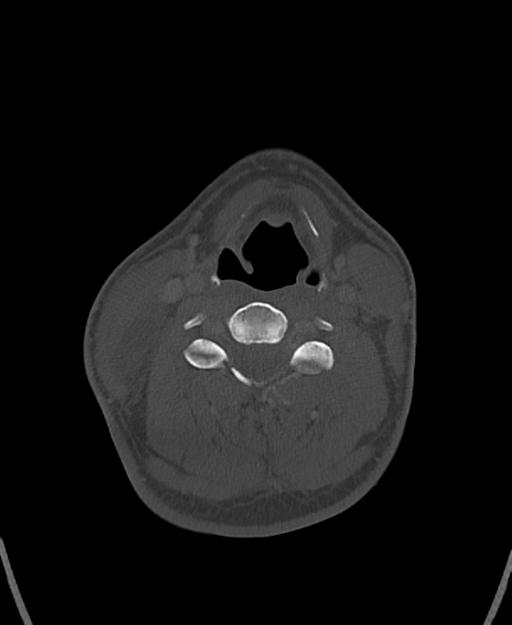 Branchial cleft cyst (Radiopaedia 31167-31875 Axial bone window 42).jpg