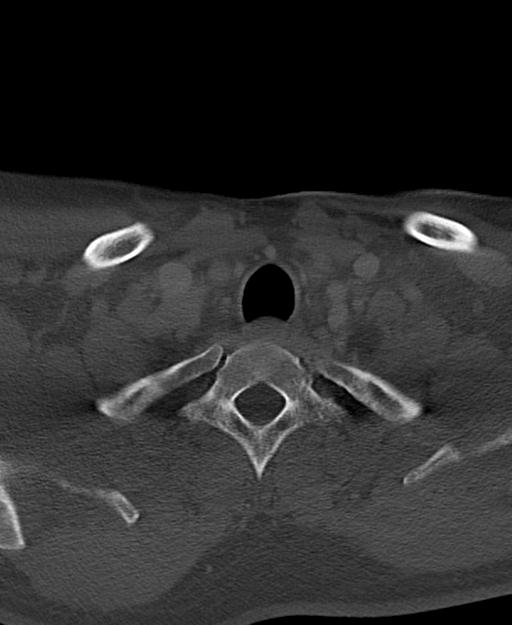 Branchial cleft cyst (Radiopaedia 31167-31875 Axial bone window 66).jpg