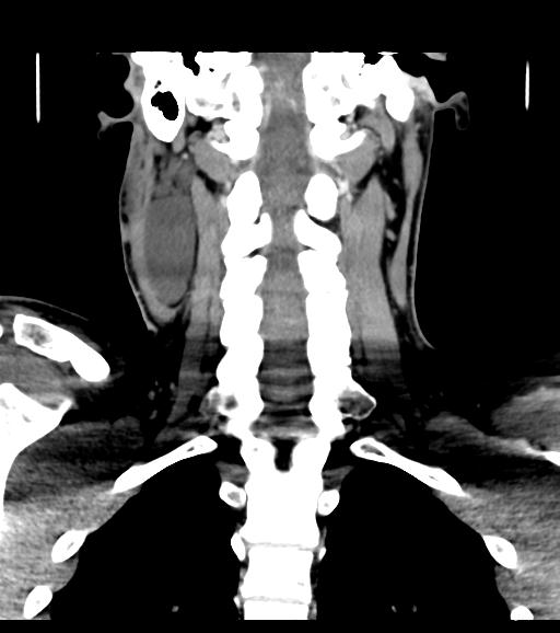 Branchial cleft cyst (Radiopaedia 31167-31875 Coronal C+ delayed 43).jpg