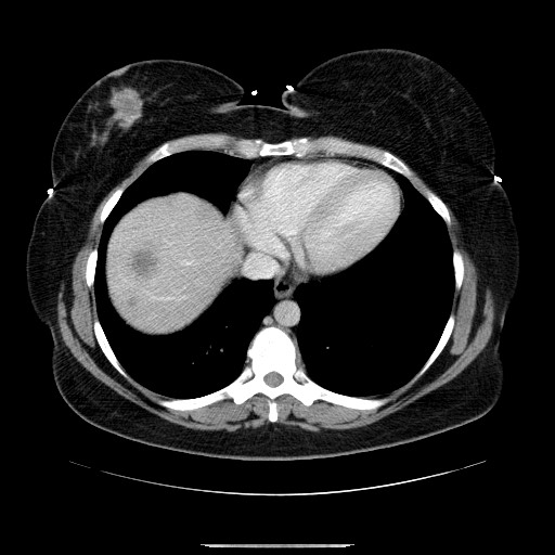 File:Breast cancer pseudocirrhosis after chemotherapy (Radiopaedia 65407-74456 A 10).jpg