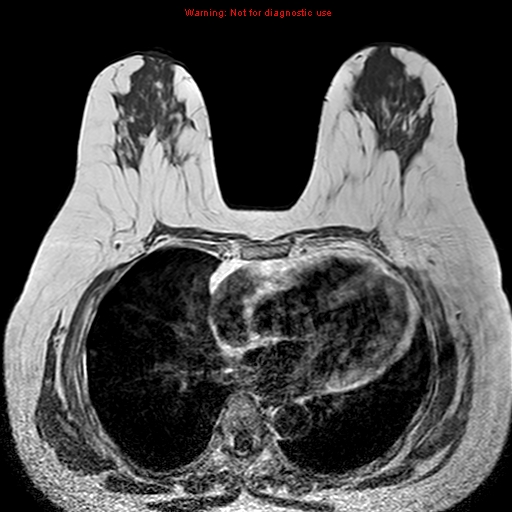 File:Breast carcinoma (multicentric multifocal in mammary Paget disease) (Radiopaedia 50966-56512 Axial T1 6).jpg