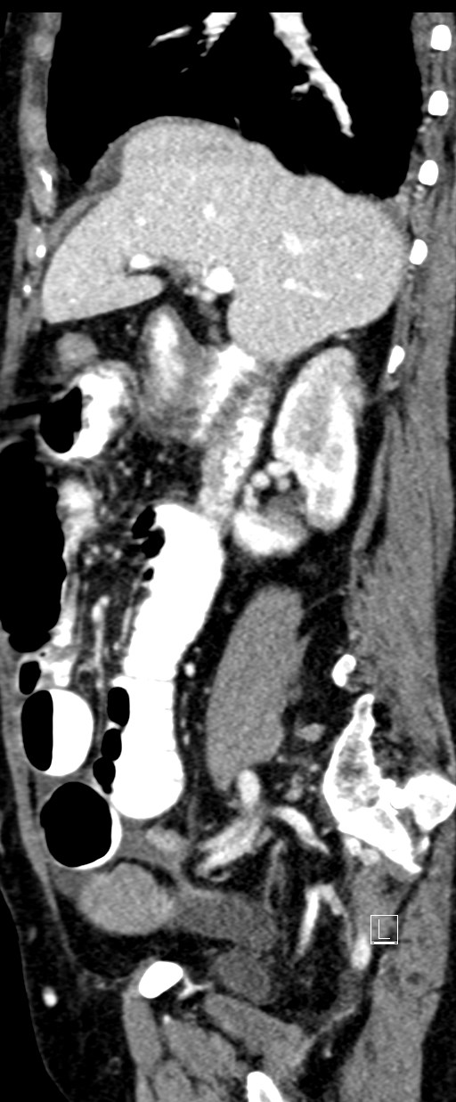Broad ligament hernia (Radiopaedia 84802-100276 C 53).jpg