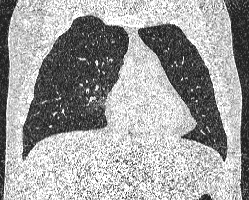 Bronchial atresia (Radiopaedia 58271-65417 Coronal lung window 17).jpg