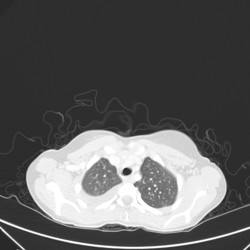 Bronchial mucoepidermoid carcinoma (Radiopaedia 57023-63895 Axial lung window 18).jpg
