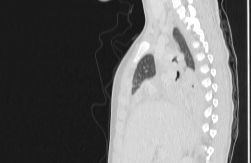 Bronchial mucoepidermoid carcinoma (Radiopaedia 57023-63895 Sagittal lung window 55).jpg