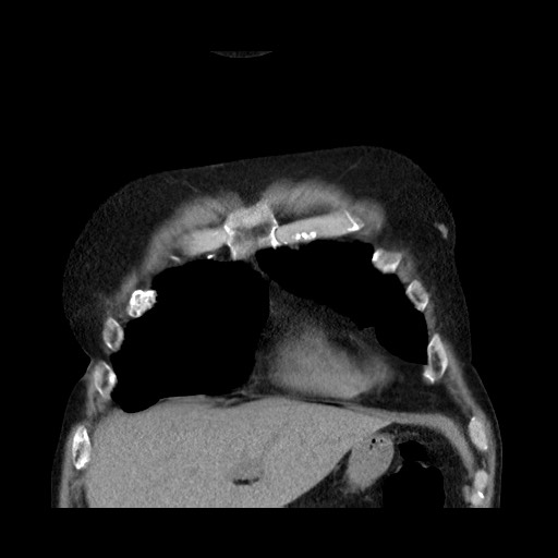 Bronchial stenosis - lung transplant (Radiopaedia 73133-83848 Coronal non-contrast 17).jpg