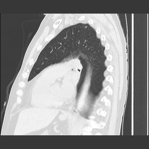 Bronchial stenosis - lung transplant (Radiopaedia 73133-83848 Sagittal lung window 42).jpg