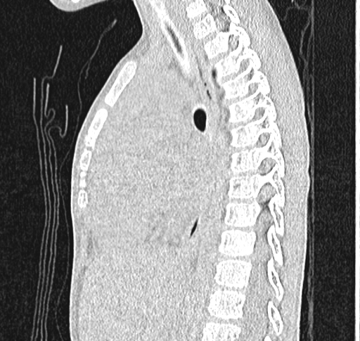 Bronchiolitis obliterans (Radiopaedia 71538-81897 Sagittal lung window 36).jpg