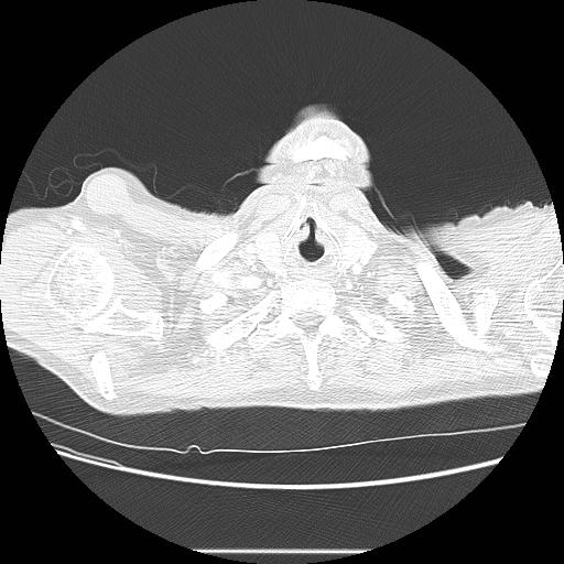 Bronchocele (Radiopaedia 17097-16795 Axial lung window 5).jpg