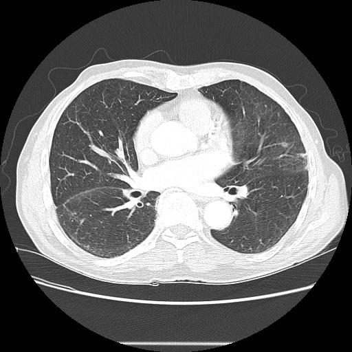 Bronchocele (Radiopaedia 17097-16795 Axial lung window 67).jpg