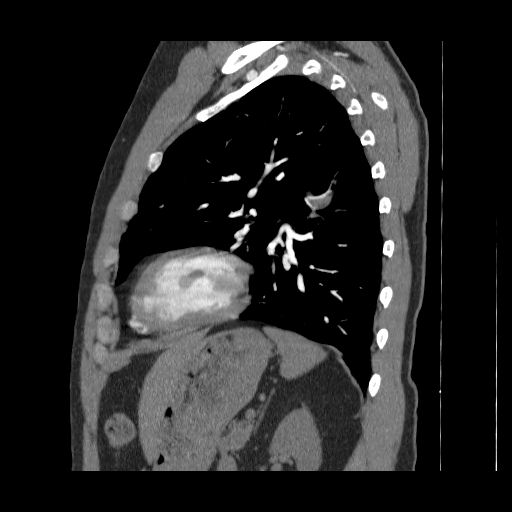 File:Bronchogenic carcinoma (Radiopaedia 47026-51562 Sagittal C+ CTPA 3).jpg