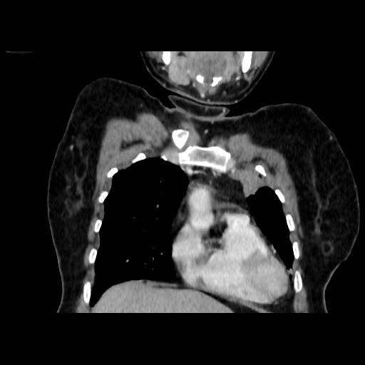 Bronchogenic carcinoma (Radiopaedia 73497-84262 C 41).jpg