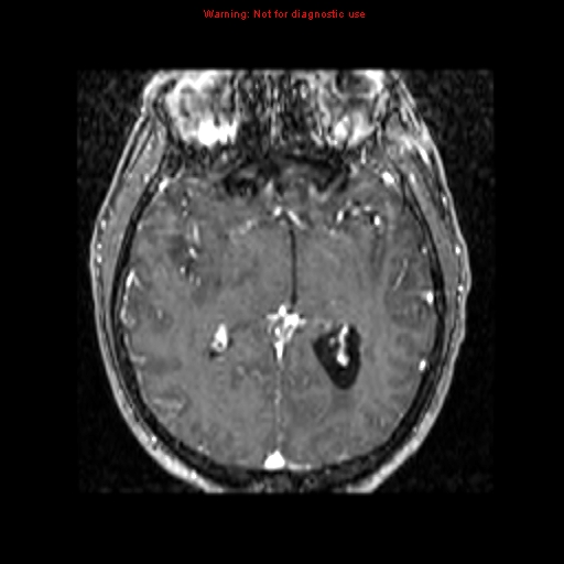 File:Bronchogenic carcinoma brain metastasis (Radiopaedia 9286-9969 Axial T1 C+ 2).jpg