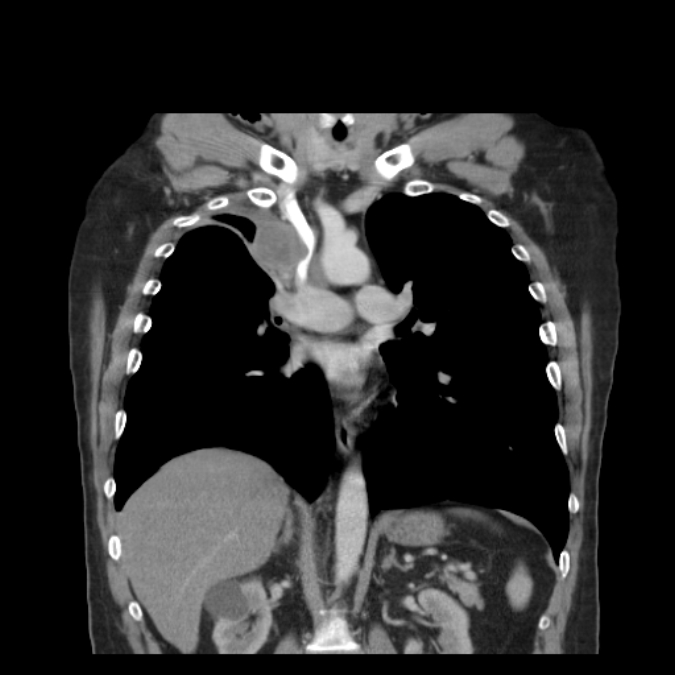 Bronchogenic carcinoma with upper lobe collapse (Radiopaedia 29297-29726 D 31).jpg