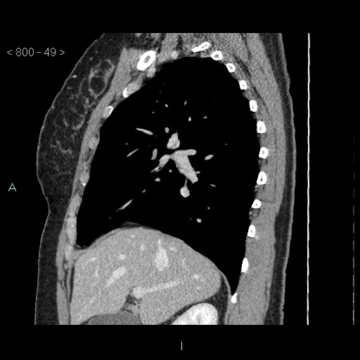 File:Bronchogenic cyst - posterior mediastinal (Radiopaedia 43885-47364 B 32).jpg