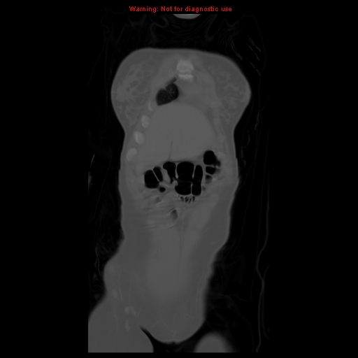 File:Brown tumor (Radiopaedia 12318-12596 D 14).jpg