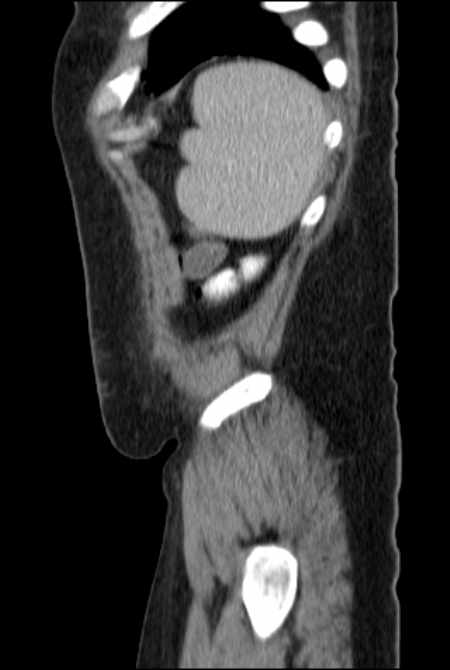 Brown tumors compressing the spinal cord (Radiopaedia 68442-77988 F 50).jpg
