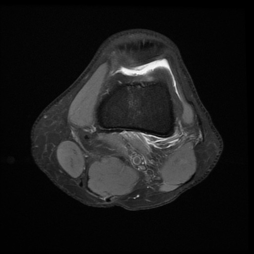 File:Bucket-handle meniscus tear (Radiopaedia 65700-74809 Axial PD fat sat 8).jpg