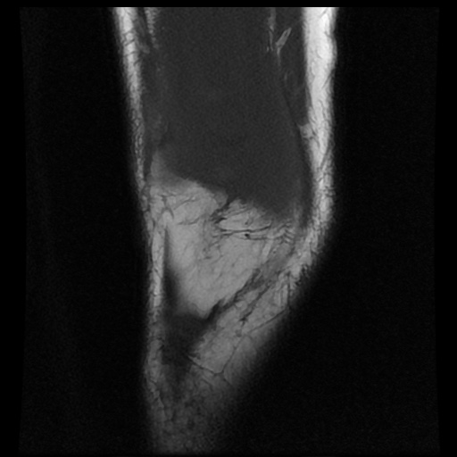 File:Bucket handle meniscus tear (Radiopaedia 56916-63751 Coronal T1 4).jpg