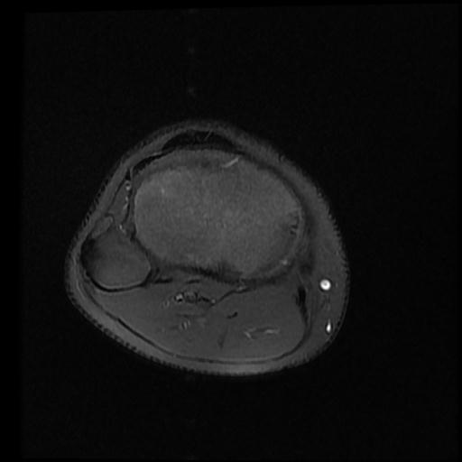 File:Bucket handle tear - lateral meniscus (Radiopaedia 72124-82634 Axial PD fat sat 14).jpg