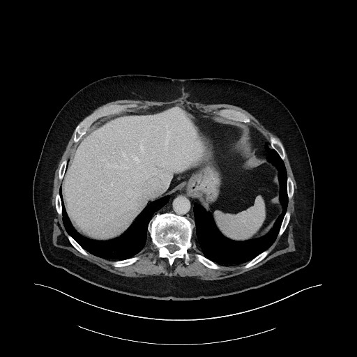 File:Buried bumper syndrome - gastrostomy tube (Radiopaedia 63843-72575 Axial 57).jpg