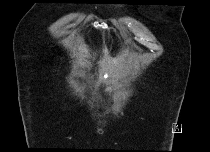 Buried bumper syndrome - gastrostomy tube (Radiopaedia 63843-72577 Coronal Inject 18).jpg