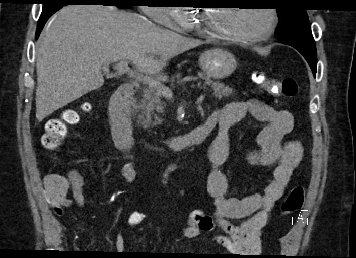 Buried bumper syndrome - gastrostomy tube (Radiopaedia 63843-72577 Coronal Inject 60).jpg