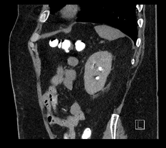 Buried bumper syndrome - gastrostomy tube (Radiopaedia 63843-72577 Sagittal Inject 26).jpg