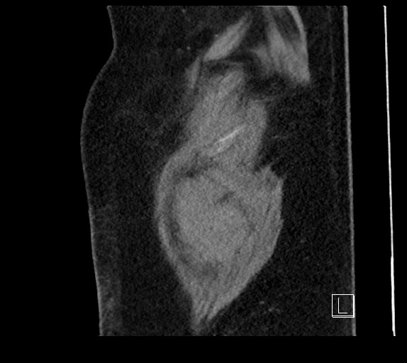 Buried bumper syndrome - gastrostomy tube (Radiopaedia 63843-72577 Sagittal Inject 4).jpg