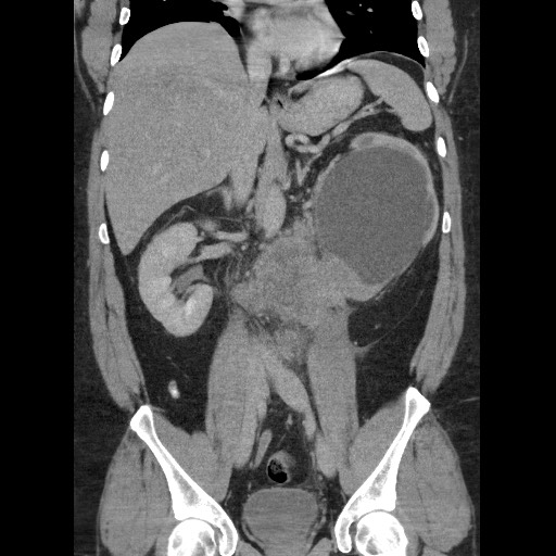 Burned-out testicular seminoma - retroperitoneal nodal metastases (Radiopaedia 62872-71245 B 38).jpg