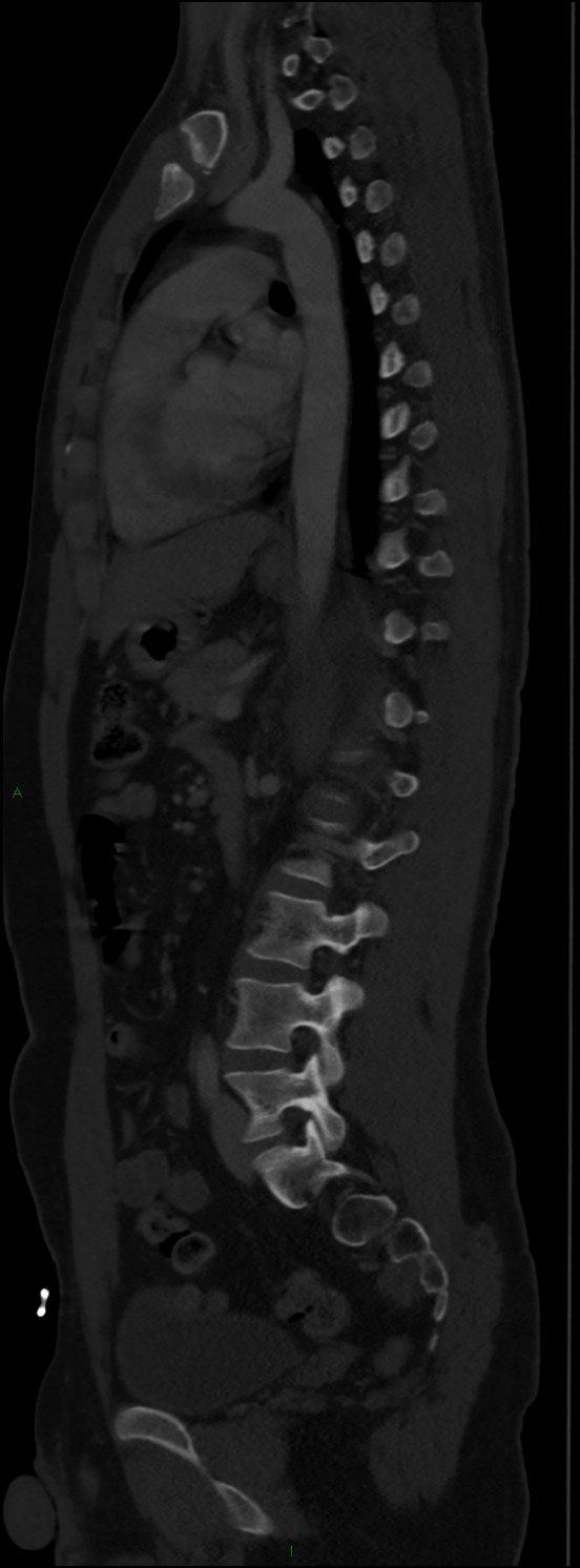 Burst fracture (Radiopaedia 83168-97542 Sagittal bone window 75).jpg