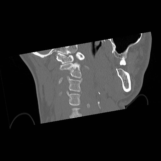 C1-C2 "subluxation" - normal cervical anatomy at maximum head rotation (Radiopaedia 42483-45607 Coronal non-contrast 14).jpg