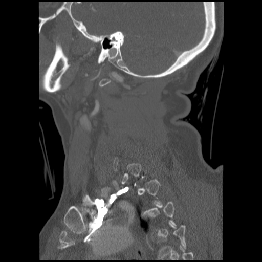 File:C1 anterior arch (plough) fracture - type 1 (Radiopaedia 76181-87720 Sagittal bone window 31).jpg