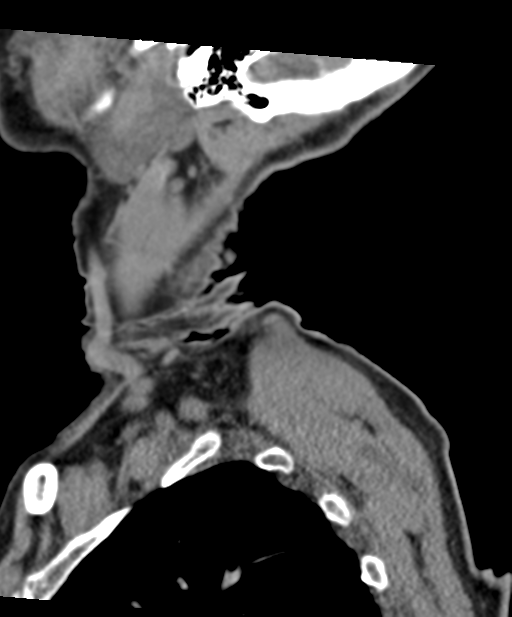 C2 fracture with vertebral artery dissection (Radiopaedia 37378-39199 D 8).png
