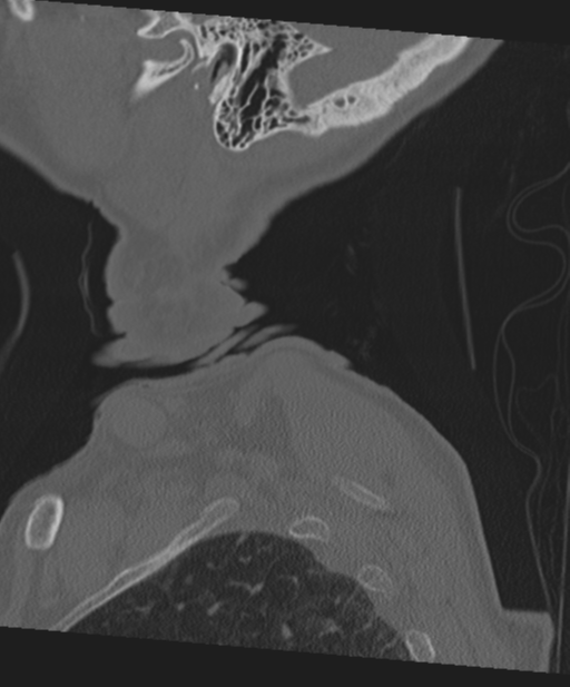 C2 fracture with vertebral artery dissection (Radiopaedia 37378-39199 Sagittal bone window 76).png