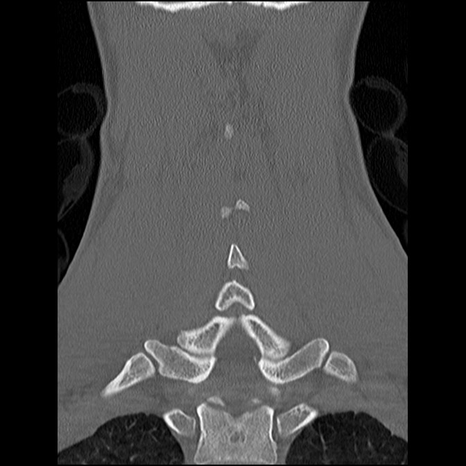 C5 facet fracture (Radiopaedia 58374-65499 Coronal bone window 43).jpg