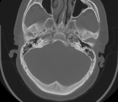 C7 laminar fracture and Klippel-Feil syndrome (Radiopaedia 86710-102850 Axial bone window 12).jpg