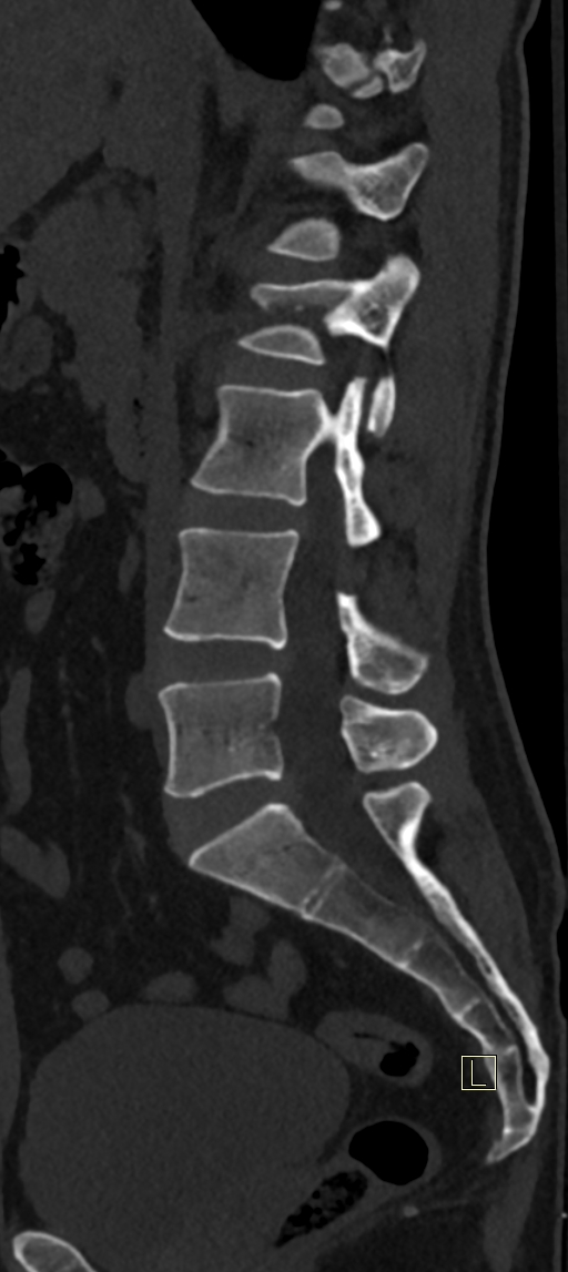 Calcaneal fractures with associated L2 burst fracture (Radiopaedia 71671-82493 Sagittal bone window 45).jpg