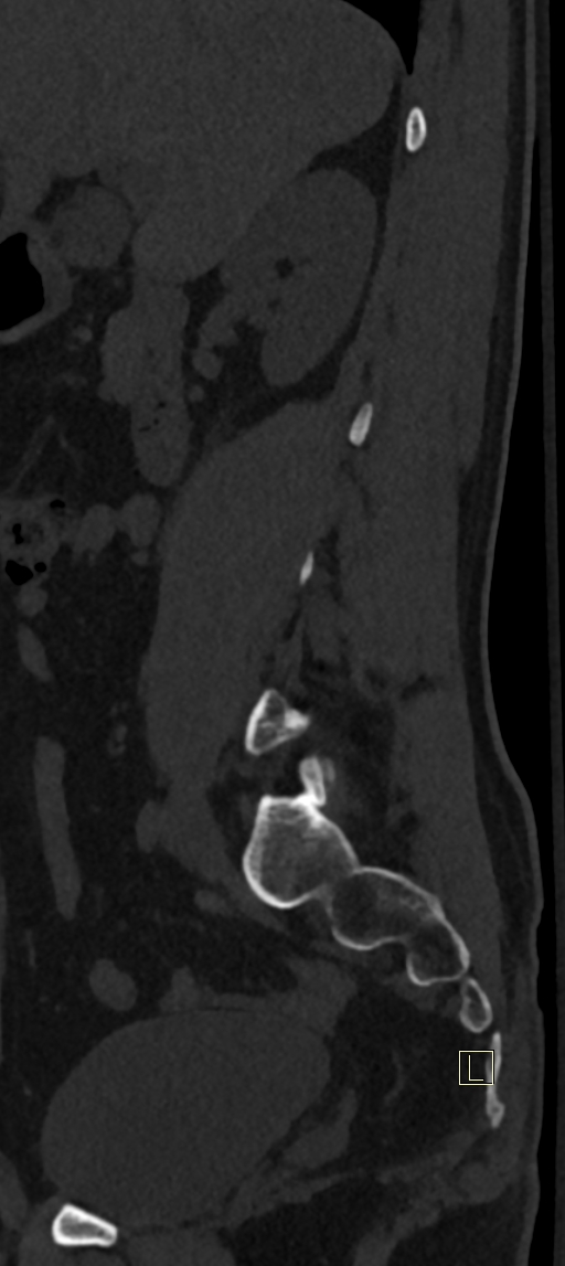 Calcaneal fractures with associated L2 burst fracture (Radiopaedia 71671-82493 Sagittal bone window 66).jpg