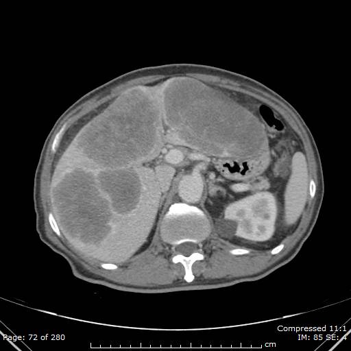 Calcified liver metastases (Radiopaedia 44699-48470 B 26).jpg