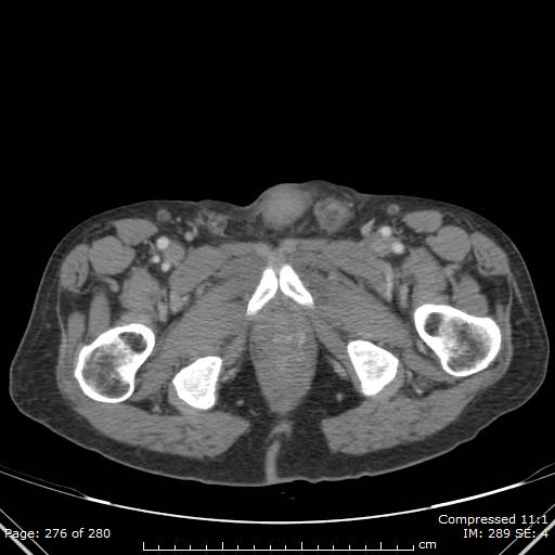 Calcified liver metastases (Radiopaedia 44699-48470 B 69).jpg