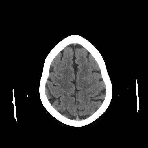 File:Calcified meningioma - cervical canal (Radiopaedia 70136-80171 Axial non-contrast 21).jpg