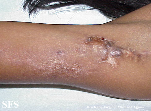 Calcinosis Circumscripta-Idiopathic (Dermatology Atlas 2).jpg