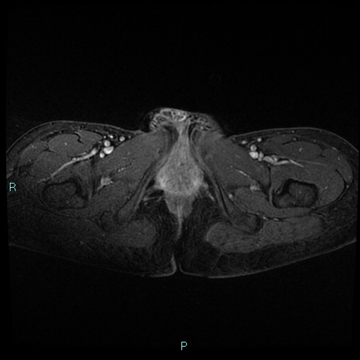 File:Canal of Nuck cyst (Radiopaedia 55074-61448 Axial T1 C+ fat sat 57).jpg