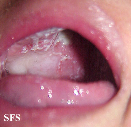 File:Candidiasis (Dermatology Atlas 14).jpg
