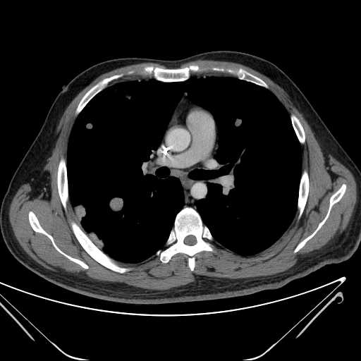 File:Cannonball pulmonary metastases (Radiopaedia 67684-77101 D 126).jpg