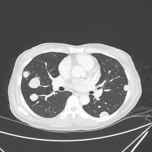 Canonball lung metastasis (Radiopaedia 77634-89837 Axial lung window 90).jpg