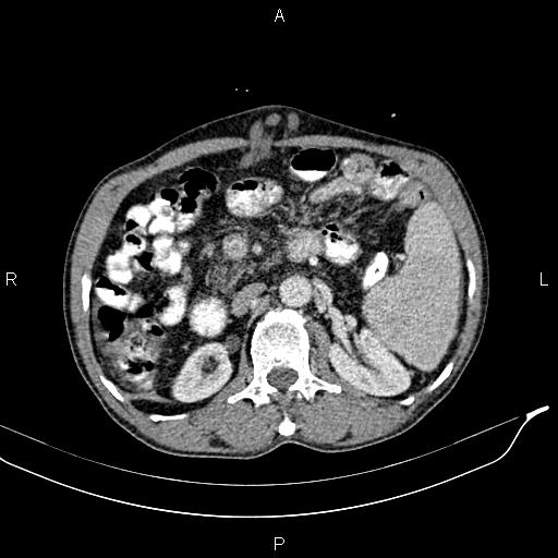 File:Caput medusae sign - portal hypertension (Radiopaedia 64007-72759 A 36).jpg